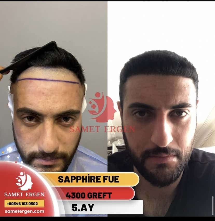 Safir FUE Saç Ekimi — 10. ay