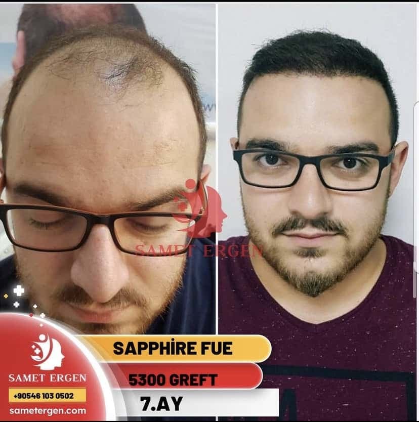 Safir FUE Saç Ekimi — 12. ay