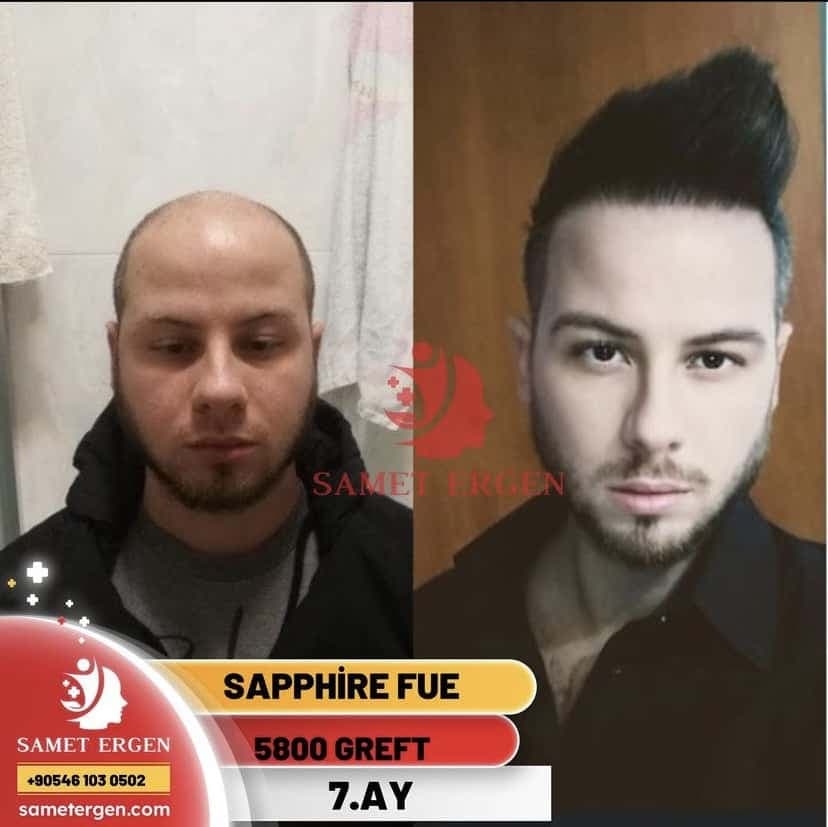 Safir FUE Saç Ekimi — 12. ay