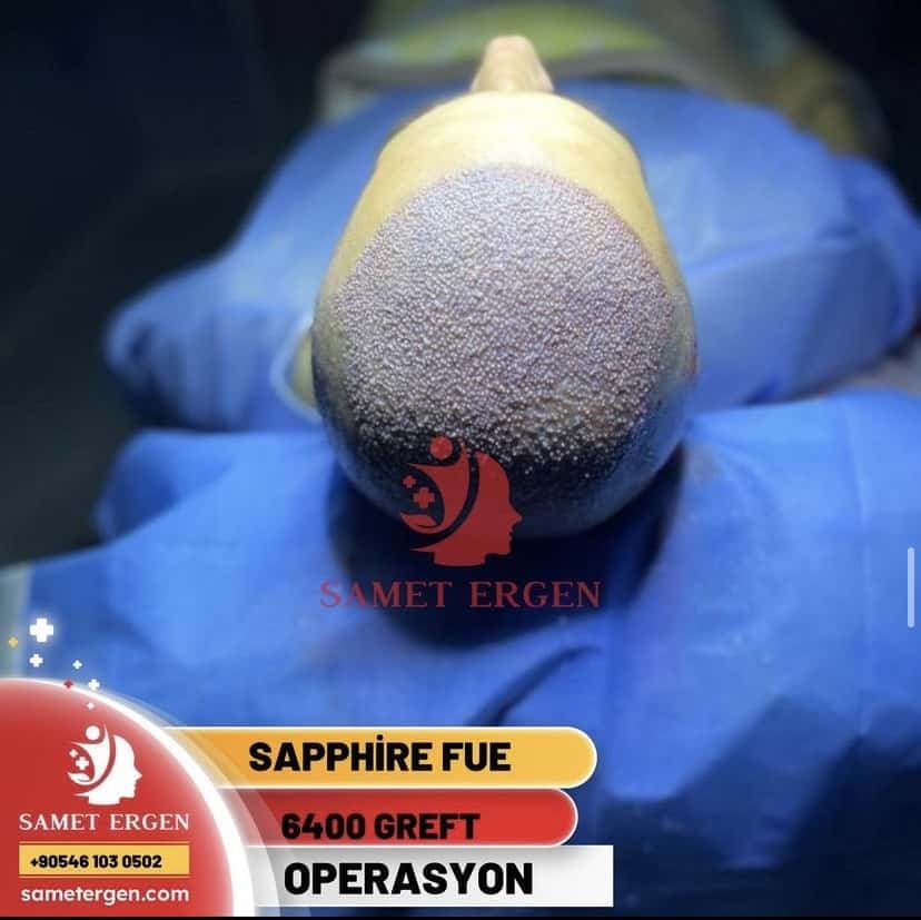 Safir FUE Saç Ekimi — 12. ay